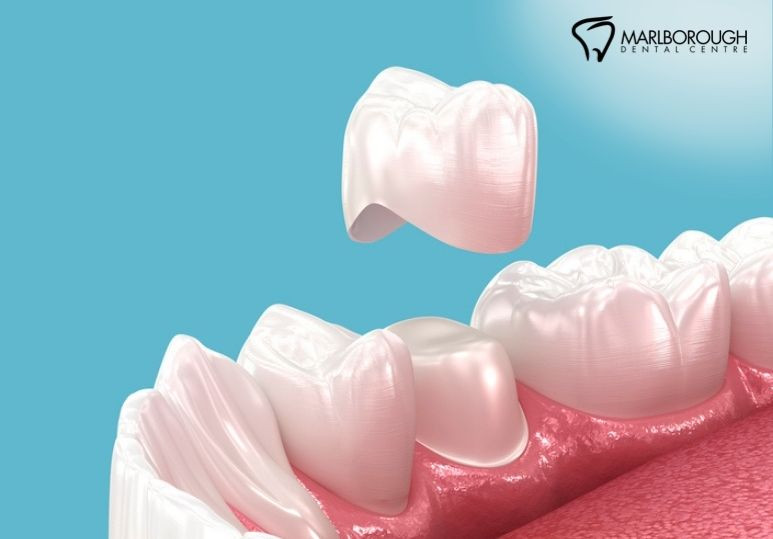 When Do You Need a Dental Crown? Common Reasons for Tooth Crowns